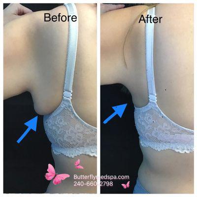 Coolsculpting for Bra fat treatment