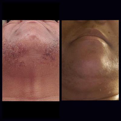 Simply Flawless Electrolysis