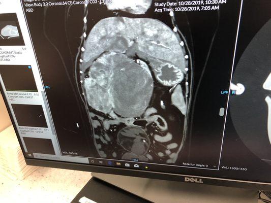 Mole's abdominal CT scan preop. Surgery removed that huge mass in the middle. He is fine  We cannot thank you enough   Janey Peterson.