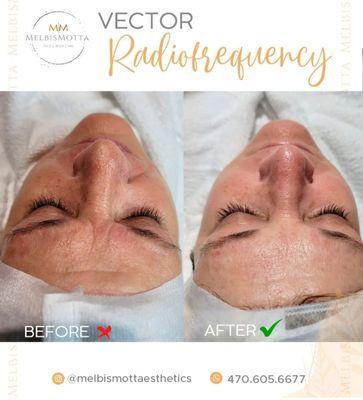 Vector Radiofrequency Facial
Especially recommended for fines lines, wrinkles and mature skins. Results from the very first session.