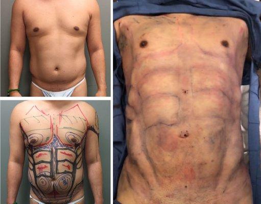 Norcal Laser Liposculpture Inc