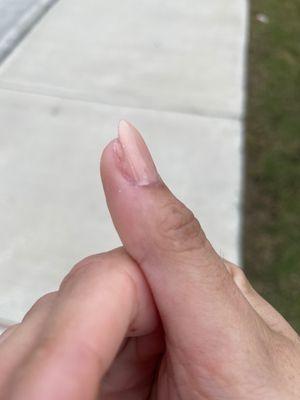 My thumb is misshapen.