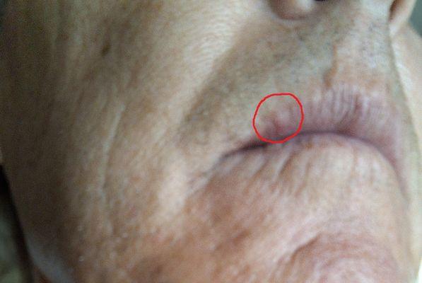 Bruising to my upper lip from mirror being pressed against it repeatedly.