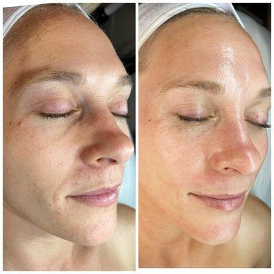Incredible skin transformation after a few skincare treatments.