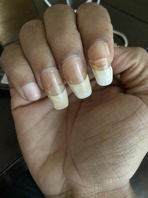 Missing pinky nail due to not properly cured acrylic application. Index finger nail just broke ugggghh