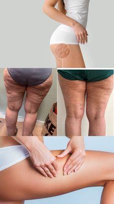 Cellulite treatment