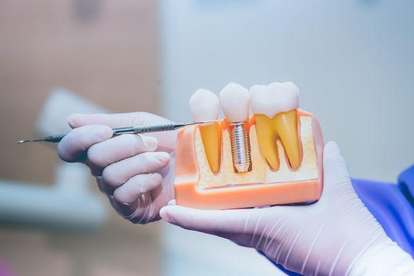 Bedrock Laser Periodontics and Implants