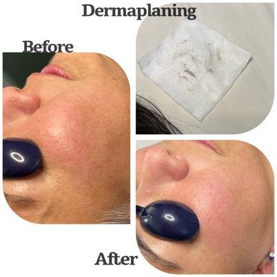 Dermaplaning Facial to exfoliate, brighten & remove unwanted hair!
