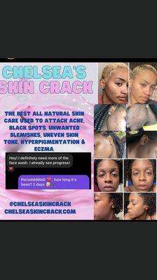 Chelsea Skin Crack