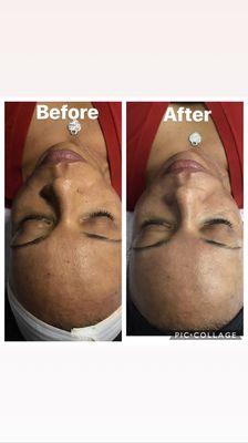 Before and after the Hydrodermabraision/Oxygen treatment.
