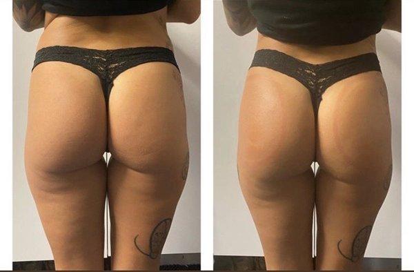 Butt enhancement/ hip dip FIX