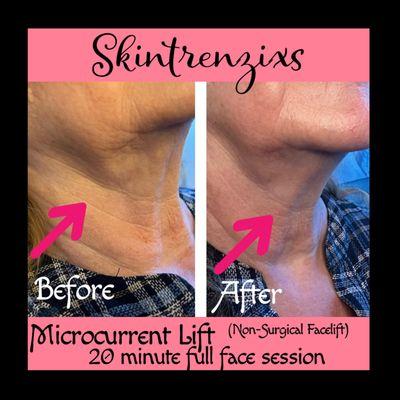 Skintrenzixs Microcurrent Lift