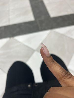 My now broken nail and the exposed area where he started to burn through to my skin.