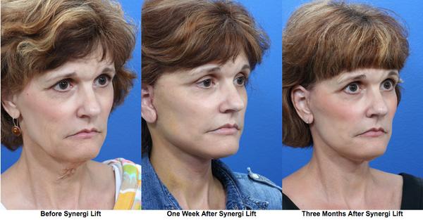 Synergi Facial Surgery