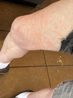 Hot coffee burn on extremely fair skin wearing shots at 5210 south college McDonald's, Wilmington NC - McAnderson's -owners.