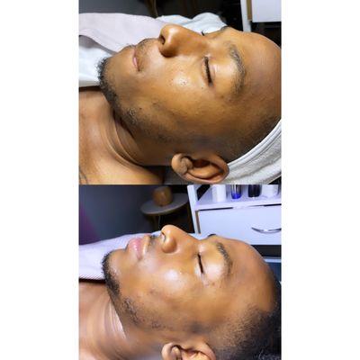 Hydra facial results