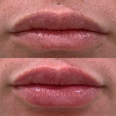 Natural looking hydration lip filler