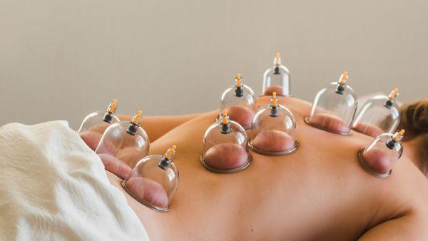 Cupping used to release muscle tension
