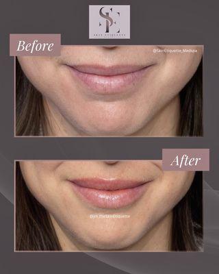 Subtle enhancement for her first lip filler