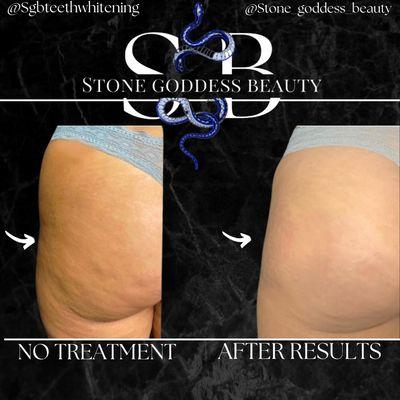 Vacuum therapy to reduce cellulite