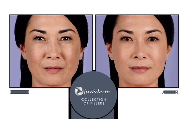 Face Logic will help reduce and remove wrinkles, plump lips, and lift cheeks with Juvéderm facial fillers.