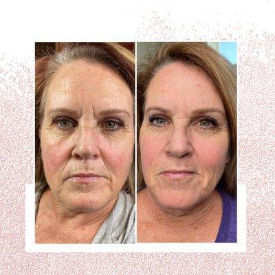 Microchanneling pro cell treatments