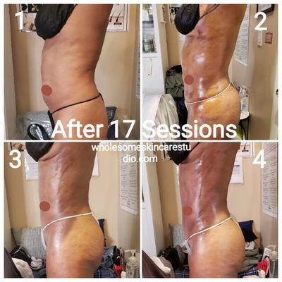 Lymphatic Drainage Post OP Recovery