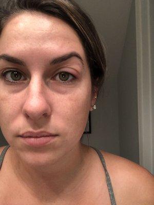 THIS IS 2 DAYS AFTER MY WAX. My eye is completely bruised and swollen