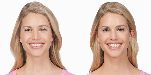 BOTOX FOR CROW'S FEET - BEFORE AND AFTER - UNDER $200