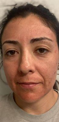 Post 1st Micro Needling Session