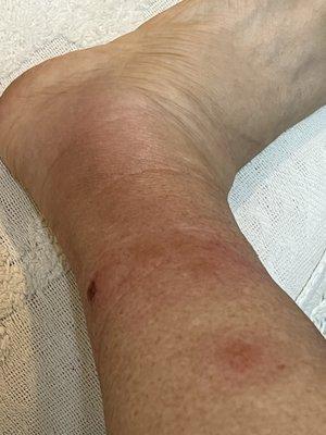 Cellulitis caused by bed bug bites at hotel