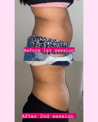 Cavitation & Radio frequency to tighten skin and help with stubborn fat