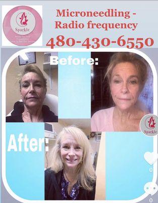 Radio frequency Gold Micro-needling
Skin tightness
Wrinkles reduction
Skin rejuvenation