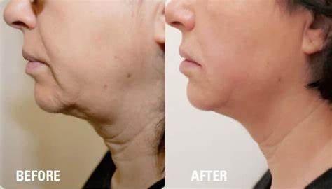 HIFU on neck to reduce fat and wrinkles and to tone and tighten loose skin .
