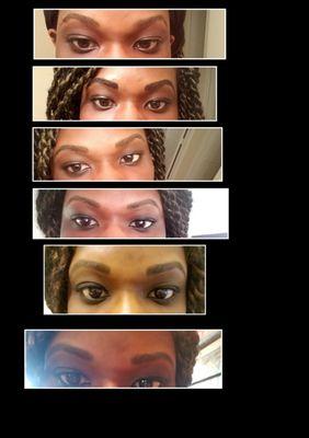Order of pics: before, 1st day, after the peeling completed, 5 months after, 9 months after, 1 year after. This is with only one session.