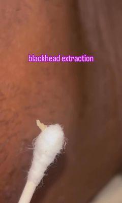 Blackhead extraction