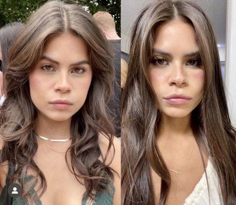 Before vs After Lip Filler