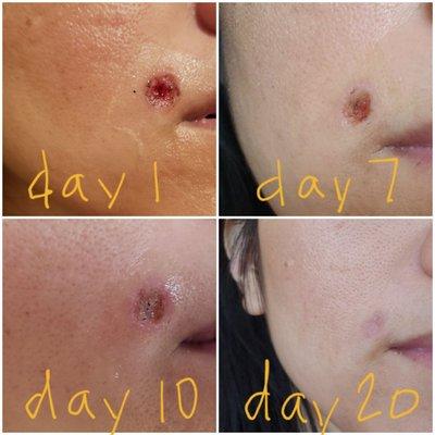 This is the progression of my healing.