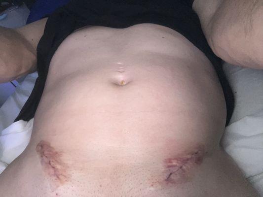 Double hernia repair with no pain meds.  Horribly painful.