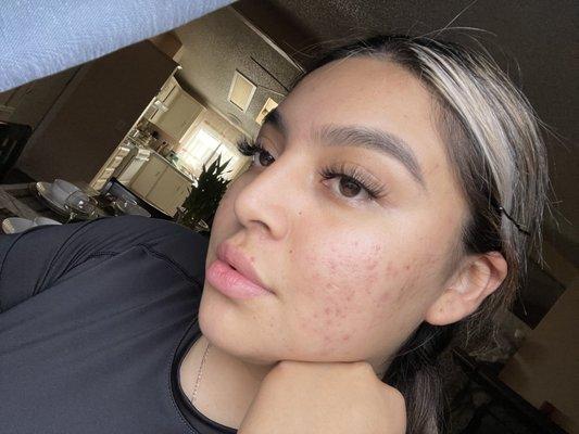 The Facial Company Acne Clinic