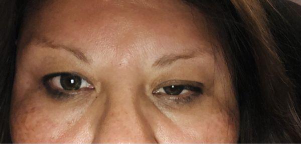 Ptosis due to malpractice