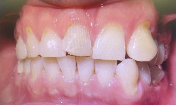 Before Invisalign