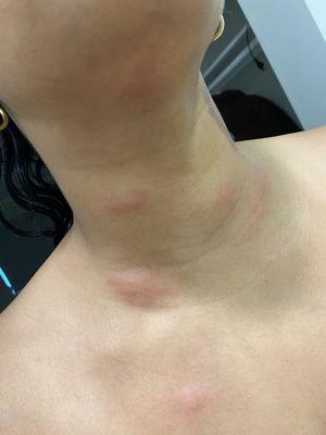 THIS HOTEL IS INFESTED WITH BED BUGS!!!!!!!