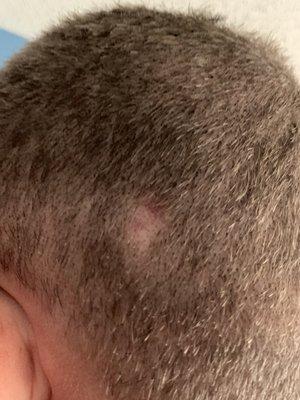 A big nickel size bald spot and cut on his left side of head.