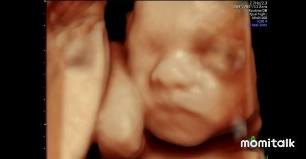 3D ultrasound