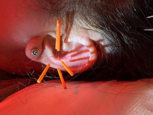 Ear acupuncture treatment