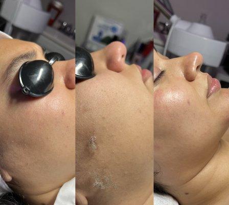 Dermaplaning procedure