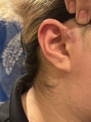 Infected incision site after 2 week stitch removal.