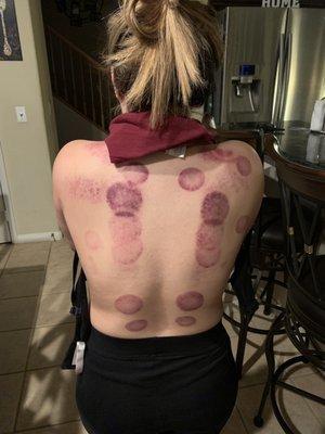 Aftermath of fire cupping