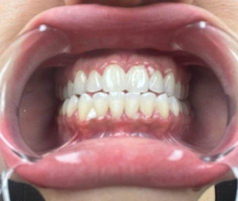 after teeth whitening